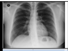 Chest x-ray, enlarged left atrium Chest x-ray, enlarged left atrium