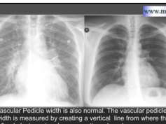 Chest x-ray - Heart failure, Kerly B lines, Pulmonary edema with Histology correlation Chest x-ray - Heart failure, Kerly B lines, Pulmonary edema with Histology correlation