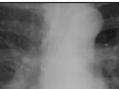 Chest x-ray , Histoplasmosis Chest x-ray , Histoplasmosis