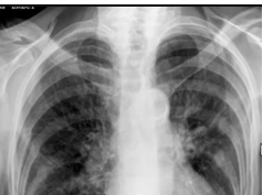 Chest x-ray, Horizontal Fissure Chest x-ray, Horizontal Fissure