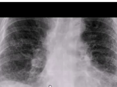 Chest x-ray, idiopathic pulmonary fibrosis, cryptogenic fibrosing alveolitis Chest x-ray, idiopathic pulmonary fibrosis, cryptogenic fibrosing alveolitis