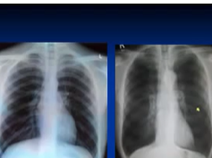 Chest x-ray interpretation --COPD and Emphysema Chest x-ray interpretation --COPD and Emphysema