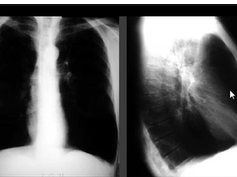 Chest x-ray interpretation -COPD, emphysema Chest x-ray interpretation -COPD, emphysema