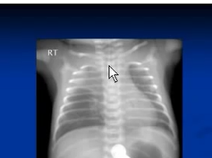 Chest x ray interpretation --ET tube Chest x ray interpretation --ET tube