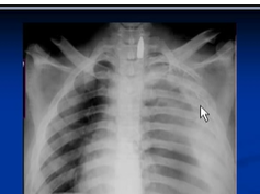 Chest x-ray interpretation, hemothorax Chest x-ray interpretation, hemothorax