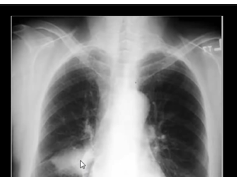 Chest x-ray interpretation, interlobular effusion Chest x-ray interpretation, interlobular effusion