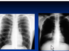 Chest x-ray interpretation -- Lung consolidation and main causes Chest x-ray interpretation -- Lung consolidation and main causes