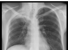 Chest x-ray interpretation -Lung volume Chest x-ray interpretation -Lung volume