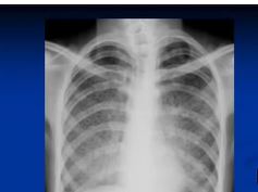 Chest x-ray interpretation -- Miliary Tuberculosis Chest x-ray interpretation -- Miliary Tuberculosis