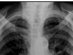 chest x-ray interpretation, mitral valve calcification chest x-ray interpretation, mitral valve calcification