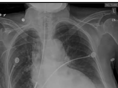 Chest x-ray interpretation, NG tube position Chest x-ray interpretation, NG tube position
