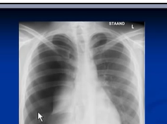 Chest x-ray interpretation, Pneumothorax Chest x-ray interpretation, Pneumothorax