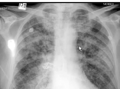 Chest x-ray interpretation, pulmonary edema, heart attack Chest x-ray interpretation, pulmonary edema, heart attack