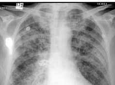 chest x-ray interpretation, pulmonary edema part 2, heart attack chest x-ray interpretation, pulmonary edema part 2, heart attack