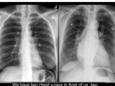 Chest x-ray interpretation - Pulmonary Edema - stag's antlers sign, Upper lobe blood diversion Chest x-ray interpretation - Pulmonary Edema - stag's antlers sign, Upper lobe blood diversion
