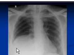 Chest x-ray interpretation --Raised hemidiaphragm Chest x-ray interpretation --Raised hemidiaphragm