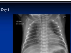 Chest x-ray interpretation, Respiratory distress syndrome Chest x-ray interpretation, Respiratory distress syndrome