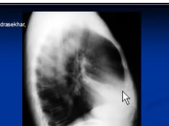 Chest x-ray interpretation --Right middle lobe collapse Chest x-ray interpretation --Right middle lobe collapse