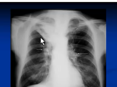 Chest x-ray interpretation -Right upper lobe collapse Chest x-ray interpretation -Right upper lobe collapse