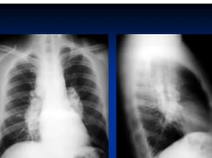 Chest x-ray --interpretation -Sarcoidosis Chest x-ray --interpretation -Sarcoidosis