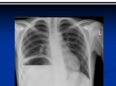 Chest x-ray interpretation --subphrenic abscess Chest x-ray interpretation --subphrenic abscess