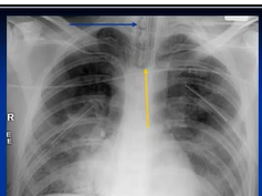 Chest x ray interpretation -Tubes and Lines Chest x ray interpretation -Tubes and Lines