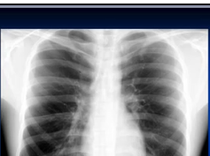 Chest x-ray interpretation Chest x-ray interpretation