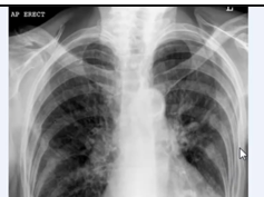 Chest x-ray, Kyphosis Chest x-ray, Kyphosis