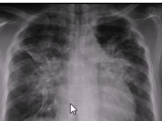 Chest x-ray, lamellar effusion Chest x-ray, lamellar effusion