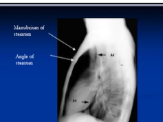 Chest X-ray, Lateral view Chest X-ray, Lateral view