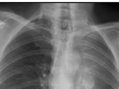 Chest x-ray, left upper lobe collapse Chest x-ray, left upper lobe collapse