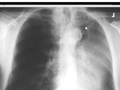 Chest x-ray - Luftsichel Sign - Left upper lobe collapse Chest x-ray - Luftsichel Sign - Left upper lobe collapse