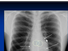 chest x-ray, Mediastinal structures -mediastinum 2/2 chest x-ray, Mediastinal structures -mediastinum 2/2