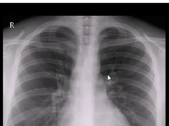 Chest x-ray, Normal, upper mediastinum Chest x-ray, Normal, upper mediastinum