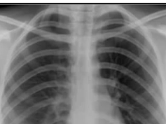 Chest x-ray --Normal Chest x-ray --Normal