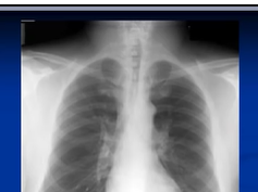 Chest x-ray -- Pleural effusion, Pneumonia Chest x-ray -- Pleural effusion, Pneumonia