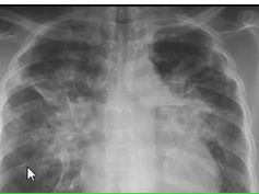 Chest x-ray, Pneumocystis carinii pneumonia, lamellar effusion Chest x-ray, Pneumocystis carinii pneumonia, lamellar effusion