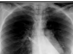 Chest x-ray --Pneumomediastinum Chest x-ray --Pneumomediastinum