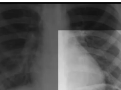Chest x-ray , pneumonia Chest x-ray , pneumonia