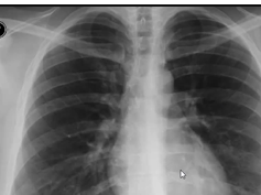 chest x-ray - pneumopericardium chest x-ray - pneumopericardium