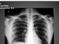Chest x-ray, pneumoperitonuem, air under diaphragms Chest x-ray, pneumoperitonuem, air under diaphragms
