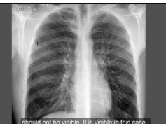Chest x-ray - Pneumothorax or no pneumothorax Chest x-ray - Pneumothorax or no pneumothorax