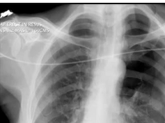 Chest x-ray --pneumothorax Chest x-ray --pneumothorax
