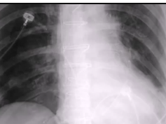 Chest x-ray, Pneumothroax on a supine film Chest x-ray, Pneumothroax on a supine film
