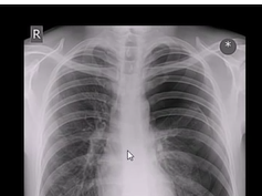 Chest x-ray, Pneumothroax Chest x-ray, Pneumothroax