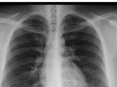 Chest x-ray -- pulmonary arterial hypertension Chest x-ray -- pulmonary arterial hypertension