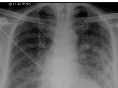 Chest x-ray, Pulmonary edema, lungs Chest x-ray, Pulmonary edema, lungs