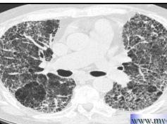 Chest x-ray - Pulmonary Fibrosis on HRCT Chest x-ray - Pulmonary Fibrosis on HRCT