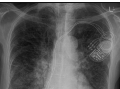 Chest x-ray --Pulmonary venous congestion Chest x-ray --Pulmonary venous congestion
