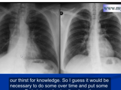 Chest x-ray -Right lower lobe collapse Chest x-ray -Right lower lobe collapse